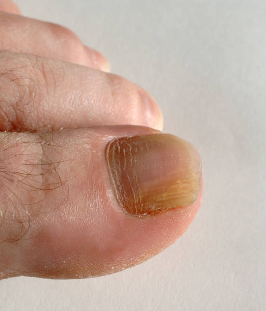 bee venom nail fungus