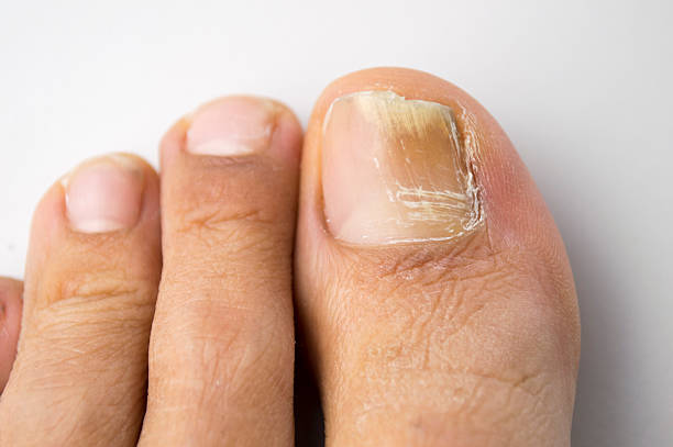 Fungal Nail Treatment Australia