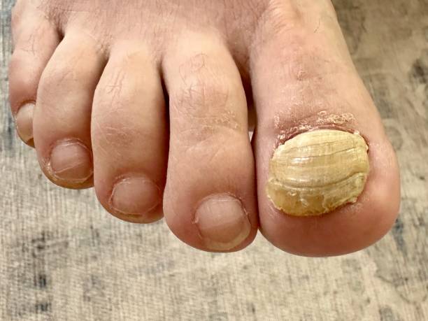 Best Nail Fungus Treatment Australia