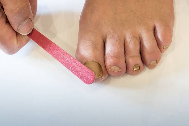 Nail Fungus After Pedicure Australia