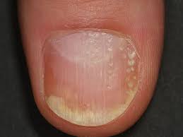 Psoriasis Nail Pitting Australia