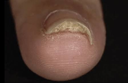 Nail Psoriasis and Gel Nails Australia