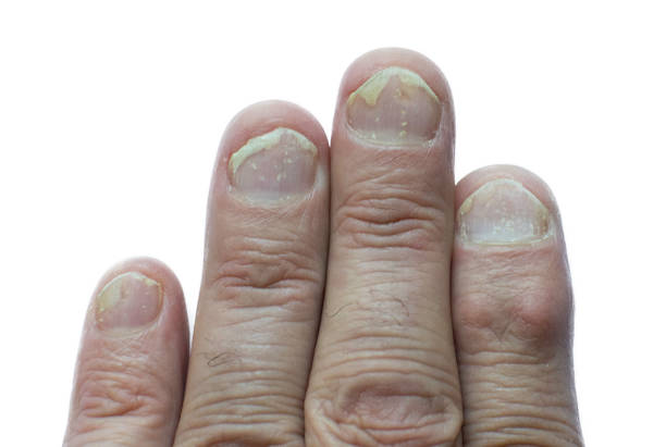 Nail Psoriasis Symptoms