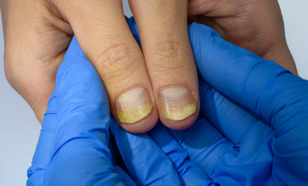 Best Nail Care for Psoriasis Australia