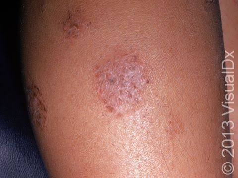 Nummular Eczema Treatment Australia