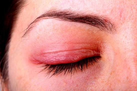 Rosacea Around Eyes Australia