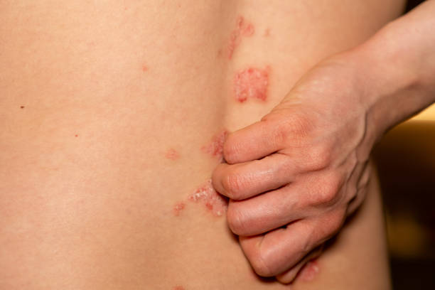 When to Change Your Psoriasis Routine Australia
