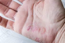 Palmoplantar Psoriasis Australia