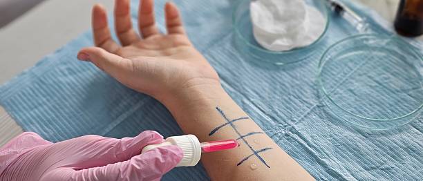 Patch Testing for Skin Allergies Australia