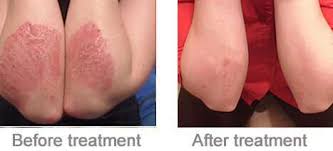 Psoriasis Phototherapy at Home