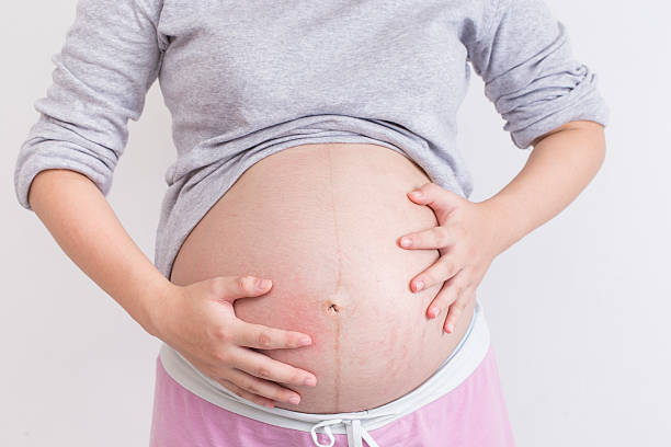 Eczema and Pregnancy Australia