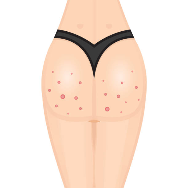 Psoriasis on Buttocks Australia