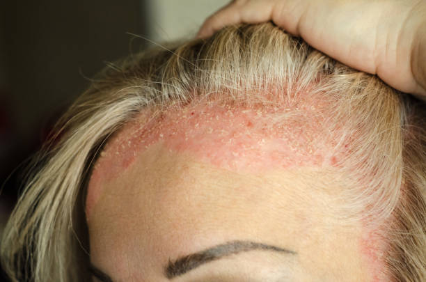 Psoriasis and Hormones Australia