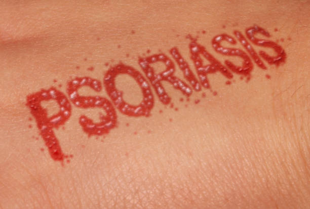 Psoriasis and Tattoos Australia