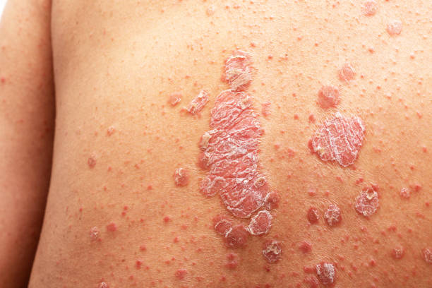 psoriasis and work australia