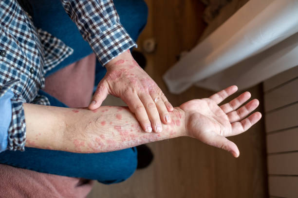 Psoriasis on Arms Australia