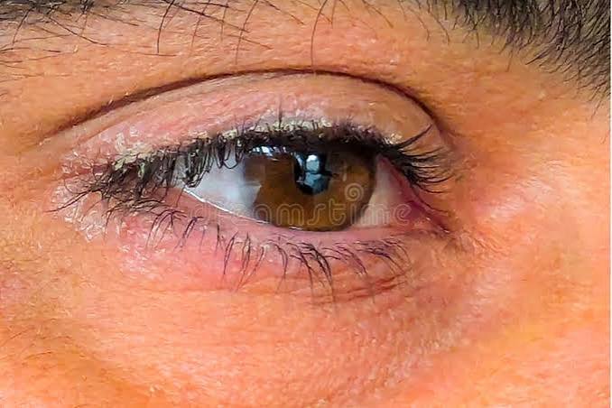 Psoriasis Around Eyes Australia