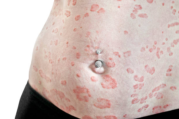 Is Psoriasis an Autoimmune Disease Australia