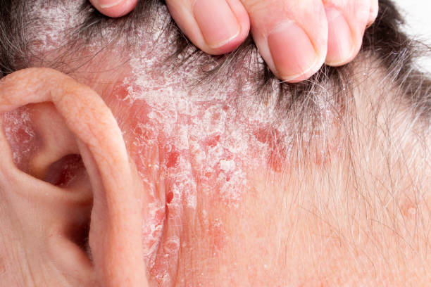 psoriasis behind ears