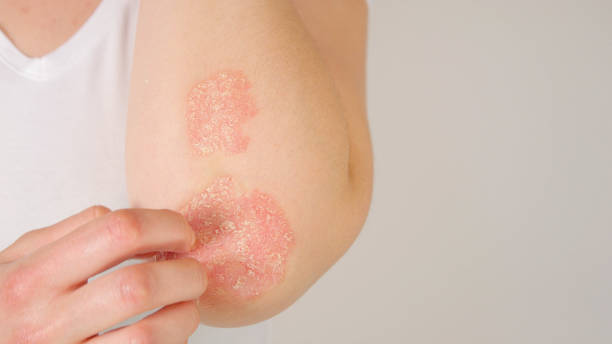 How to Prevent Psoriasis Flare Ups