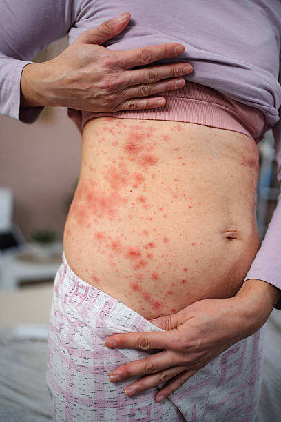 Psoriasis Clothing Irritation Australia