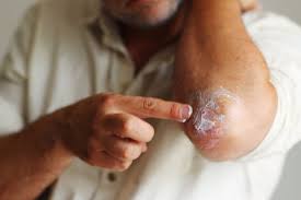 why use bee venom cream