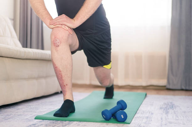 psoriasis and exercise australia