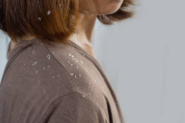 Scalp Psoriasis Flakes on Clothes Australia
