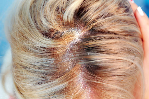 Psoriasis Flakes in Hair