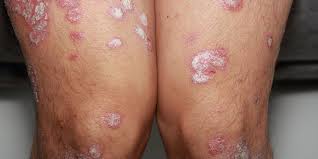 why psoriasis flares up