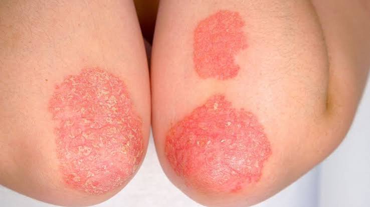 Psoriasis and Infection Australia
