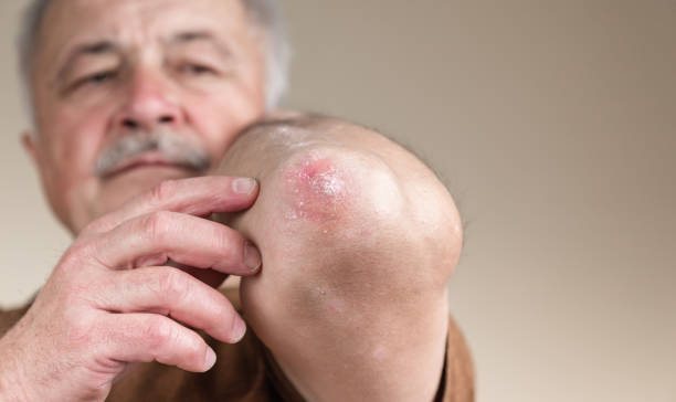 Psoriasis in Elderly Australia