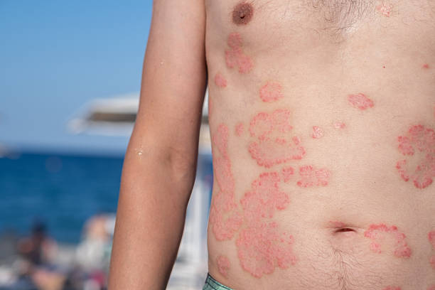 psoriasis and sun exposure australia