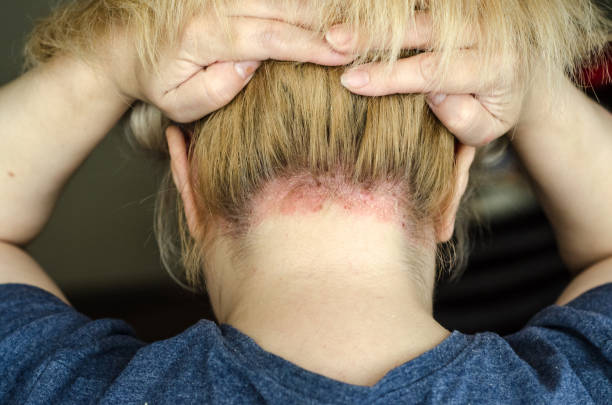 Scalp Psoriasis With Thick or Long Hair Australia