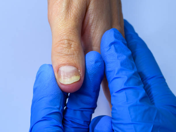 Nail Psoriasis Treatment Australia