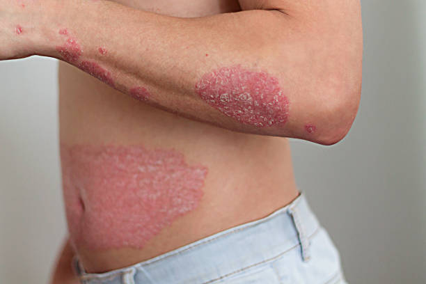 Psoriasis on Stomach and Abdomen Australia