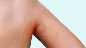 Psoriasis on Armpits Australia