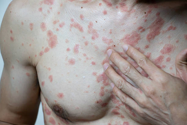 psoriasis on chest and torso australia