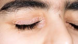 psoriasis on eyelids australia