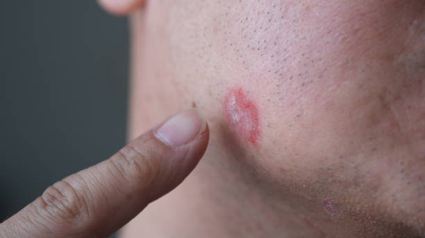 Psoriasis on Face Australia