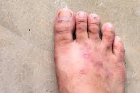 Psoriasis on Feet Australia