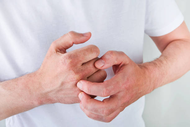 psoriasis on hands and fingers australia