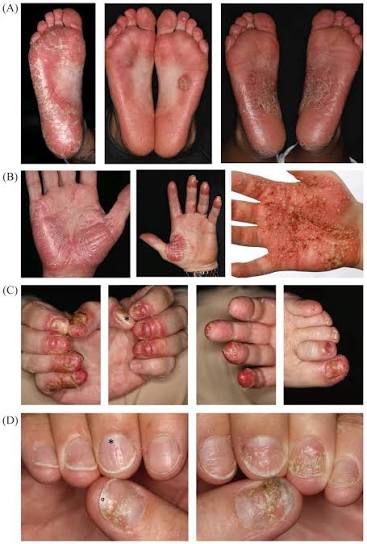 Best Psoriasis Treatment for Hands and Feet Australia