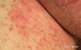 Psoriasis on Inner Thighs Australia