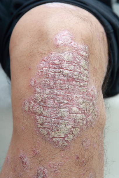 psoriasis on knees australia