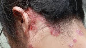Psoriasis on Neck Australia