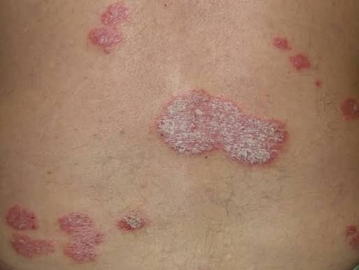 Thick Skin Plaques Australia