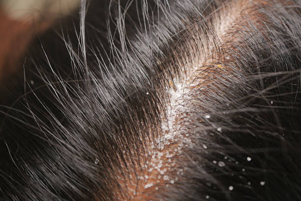 Psoriasis Scabs on Scalp Australia