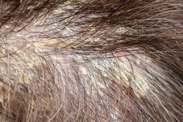 psoriasis scalp routine australia