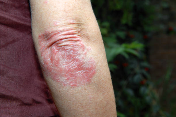 Fragrance and Psoriasis-Prone Skin Australia